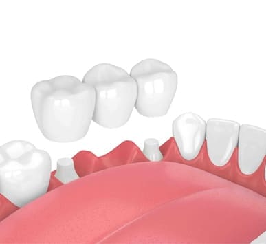 Dental Crowns And Bridges