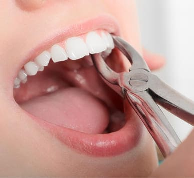 Tooth Extraction Wisdom tooth removal